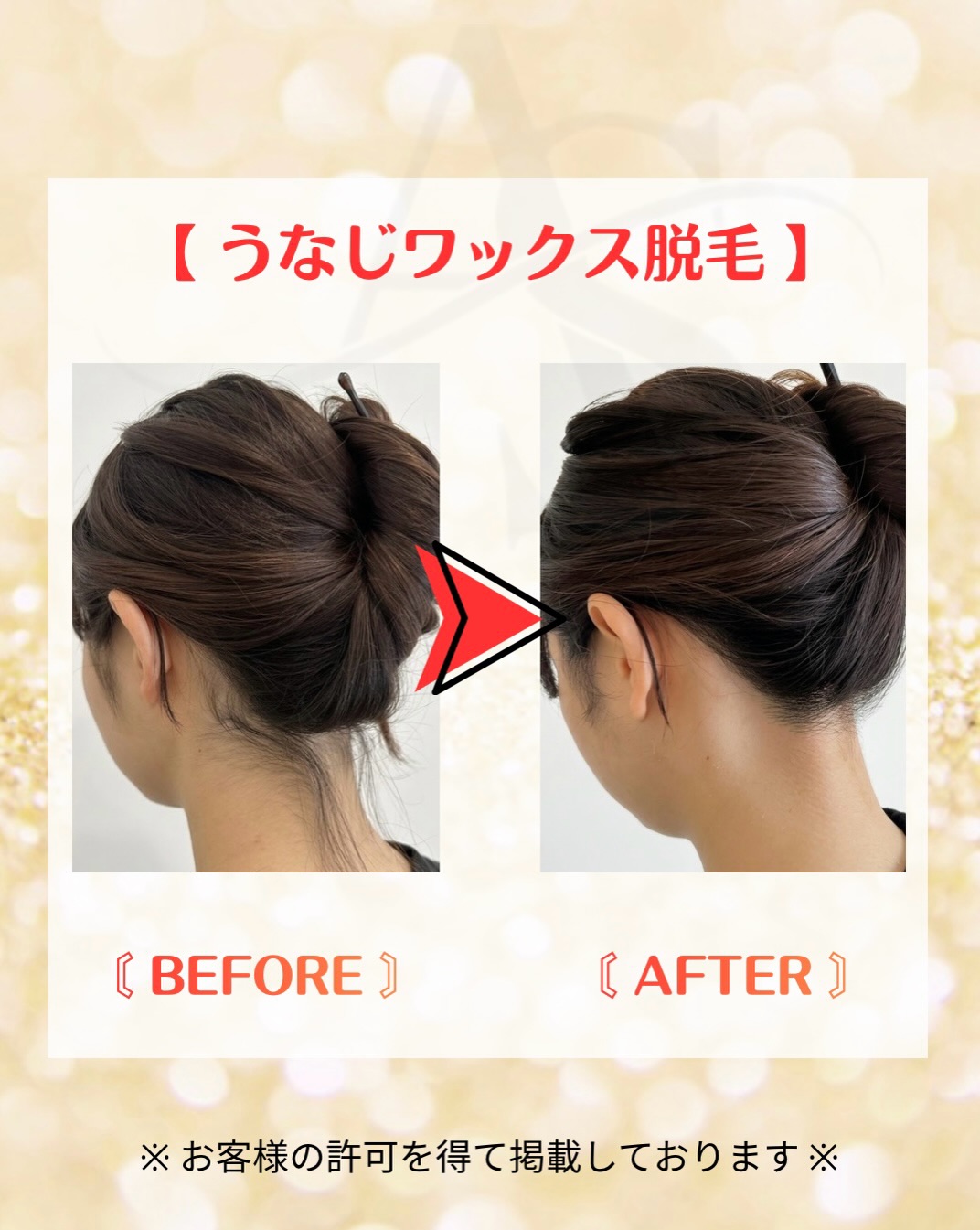 うなじワックス脱毛の施術前と施術後の比較|東広島市西条の女性専用サロンARSHA